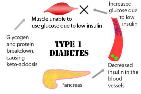 Causes of diabetes type 1