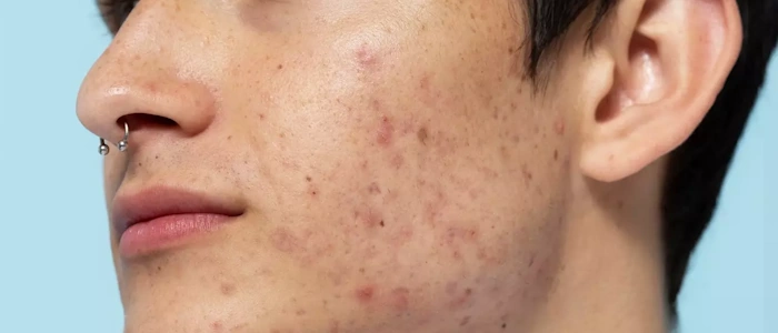 Τι πρέπει να γνωρίζουμε για την ακμή