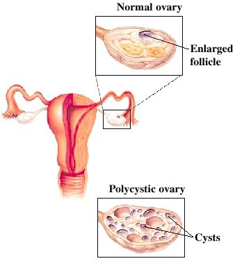 pcos1