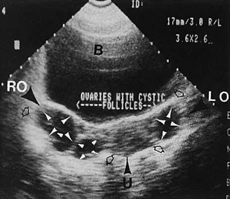 αγωνίζεται να χάσει βάρος με pcos λάδι λιναρόσπορου για απώλεια βάρους